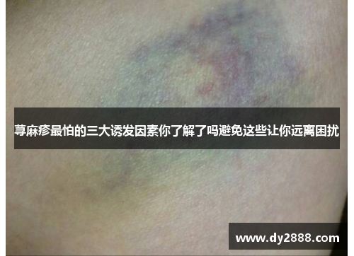 荨麻疹最怕的三大诱发因素你了解了吗避免这些让你远离困扰